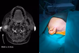 Loại bỏ nguy cơ liệt mặt nhờ máy dò thần kinh khi mổ u tuyến nước bọt