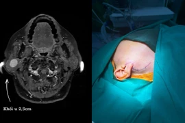 Loại bỏ nguy cơ liệt mặt nhờ máy dò thần kinh khi mổ u tuyến nước bọt