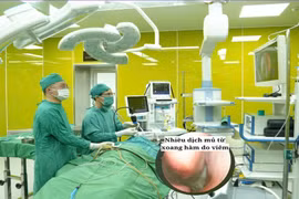 Vẹo vách ngăn mũi, thủ phạm thầm lặng gây bệnh nguy hiểm