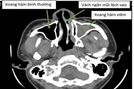 Vẹo vách ngăn mũi, thủ phạm thầm lặng gây bệnh nguy hiểm