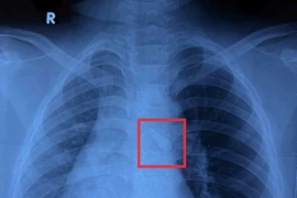 Phẫu thuật thành công lấy dị vật răng trong đường thở bé trai 10 tuổi
