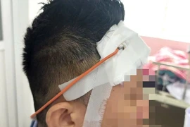 2 tháng sau tai nạn mới bị máu tụ chèn ép não