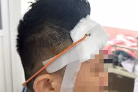 2 tháng sau tai nạn mới bị máu tụ chèn ép não