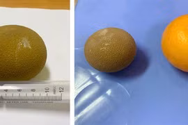 Đau bụng,... không ngờ sỏi chiếm gần hết thể tích bàng quang