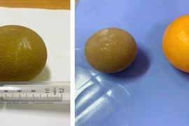 Đau bụng,... không ngờ sỏi chiếm gần hết thể tích bàng quang