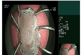 Đồng thời điều trị 2 ung thư đường tiêu hóa bằng kỹ thuật nội soi ít xâm lấn