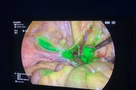 Ứng dụng huỳnh quang điều trị ung thư phụ khoa giai đoạn sớm