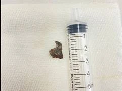 Dị vật mắc trong đường thở người bệnh 64 tuổi nhiều tháng gây ho triền miên