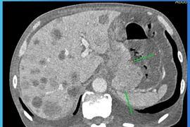 Can thiệp cầm máu thành công cho bệnh nhân ung thư dạ dày xuất huyết nặng