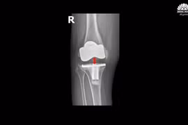 Chữa thành công biến chứng khớp gối nhân tạo hiếm gặp sau 5 năm