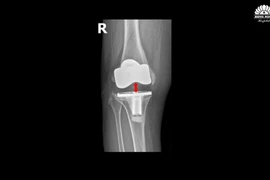 Chữa thành công biến chứng khớp gối nhân tạo hiếm gặp sau 5 năm
