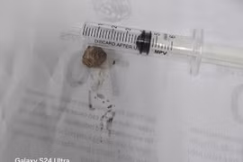 Lấy sỏi niệu quản 2 cm ngừa biến chứng hỏng thận