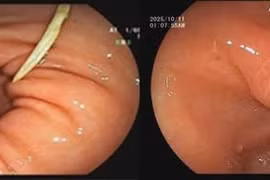 Lấy mảnh xương gà mắc kẹt trong dạ dày 4 ngày