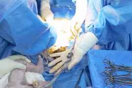 Cứu thai nhi 38 tuần bị dây rốn thắt nút, quấn cổ 2 vòng