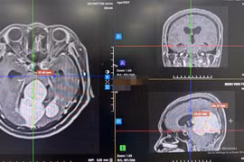 Đau đầu, giảm thị lực người phụ nữ 56 tuổi phát hiện u màng não lớn