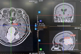 Đau đầu, giảm thị lực người phụ nữ 56 tuổi phát hiện u màng não lớn