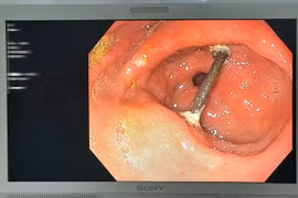 Thủng dạ dày do mảnh cây trong thuốc tự sắc