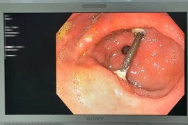 Thủng dạ dày do mảnh cây trong thuốc tự sắc