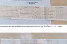 Cứu thành công bệnh nhân cơn nhịp nhanh kịch phát trên thất