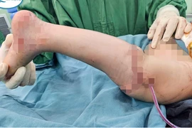 Xoay cẳng chân 180 độ, tạo khớp gối cho trẻ 5 tuổi bị thiểu sản xương đùi 