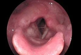 Nội soi khâu treo dây thanh cho người bệnh liệt dây thanh quản