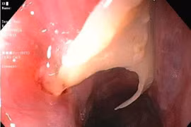 Cảnh báo nguy hiểm từ dị vật hóc xương thực quản dịp Tết