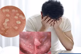 Nhận biết sùi mào gà niệu đạo, cách phòng tránh 