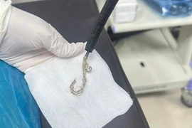 Gắp lắc bạc trong dạ dày bệnh nhi 2 tuổi