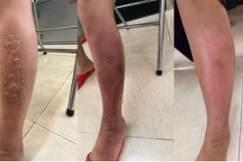 0xy cao áp hồi phục bỏng tránh sẹo lồi, sẹo co kéo cho trẻ bị bỏng