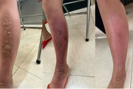 0xy cao áp hồi phục bỏng tránh sẹo lồi, sẹo co kéo cho trẻ bị bỏng