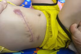 Truyền 2.300 ml máu cứu trẻ hơn 2 tuổi vỡ gan nguy kịch