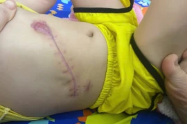 Truyền 2.300 ml máu cứu trẻ hơn 2 tuổi vỡ gan nguy kịch