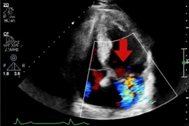 40 năm sống khỏe mạnh, người đàn ông bàng hoàng phát hiện bệnh tim nguy hiểm