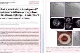 Ca bệnh hiếm gặp nhồi máu cơ tim cấp đồng thời xuất huyết não