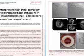 Ca bệnh hiếm gặp nhồi máu cơ tim cấp đồng thời xuất huyết não