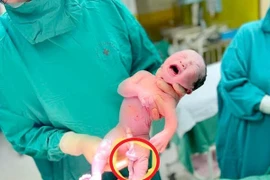 Dây rốn xoắn nhiều vòng, thai nhi thoát khỏi cửa tử nhờ bất thường hiếm gặp