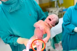 Dây rốn xoắn nhiều vòng, thai nhi thoát khỏi cửa tử nhờ bất thường hiếm gặp