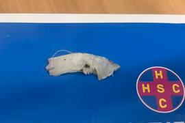 Người đàn ông 63 tuổi suýt gặp biến chứng nguy hiểm vì mảnh xương cá dài 4cm