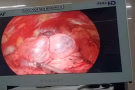 Làm chủ phẫu thuật cắt kén khí phổi ngay tại Ninh Bình