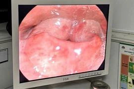 Hiếm gặp, từ đau họng cấp tính đến nguy kịch vì phù nề thanh quản trong 5 giờ