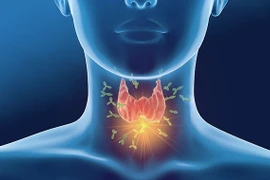 Nhiều loại viêm tuyến giáp ảnh hưởng nghiêm trọng sức khỏe