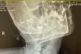 Đặt nội khí quản cho người bệnh bị vẹo cột sống cổ bẩm sinh