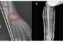 Ứng dụng kỹ thuật C-arm trong phẫu thuật xương gãy không để lại sẹo