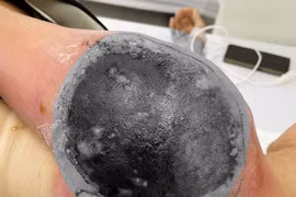 Nhiễm trùng huyết vì đắp lá chữa chấn thương vai