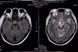 Bất thường ở mắt không ngờ u não khổng lồ