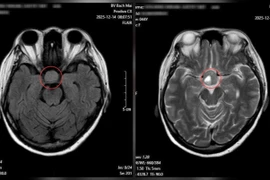 Bất thường ở mắt không ngờ u não khổng lồ