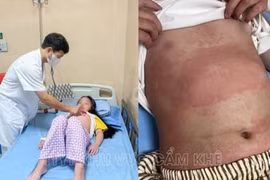 Nhiều trẻ cấp cứu trong đêm vì ban nhiễm khuẩn