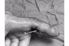 Sự cố máy bắn đinh gây tai nạn lao động nguy hiểm