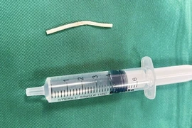 Không sờ thấy que tránh thai, phải nhập viện vì đau cánh tay