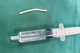 Không sờ thấy que tránh thai, phải nhập viện vì đau cánh tay